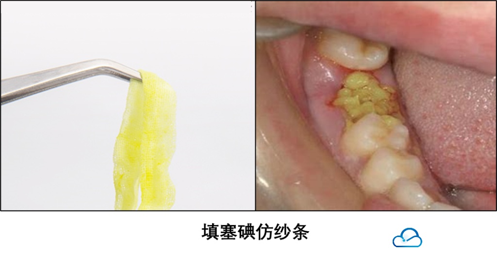 带你认识干槽症